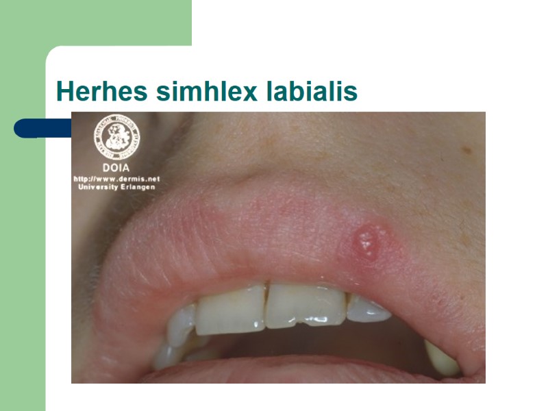 Herhes simhlex labialis